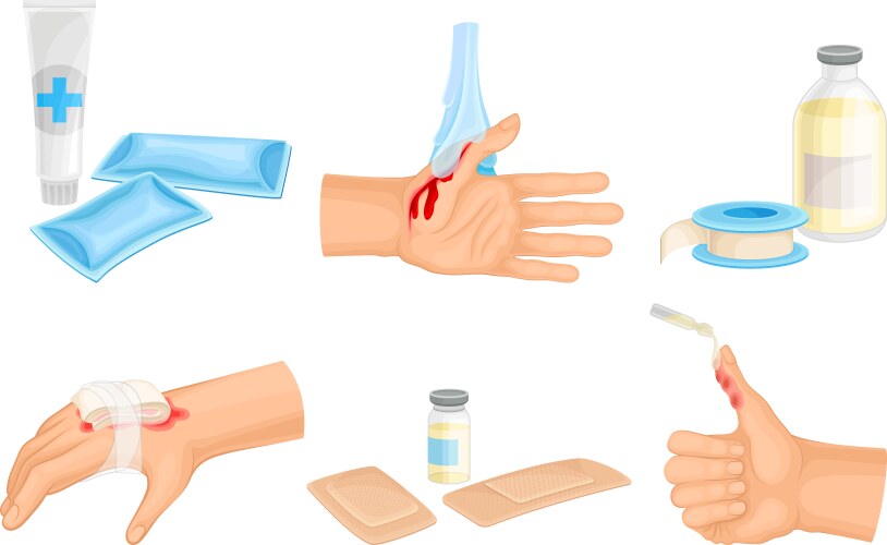 طرق علاج الحروق